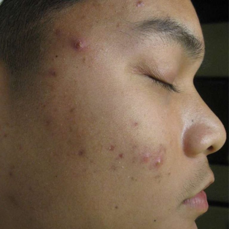 Massiel photo work acne - before