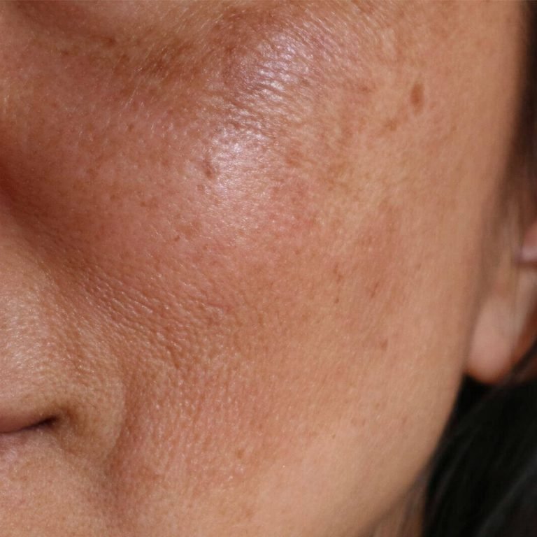 Skin besties . Hyperpigmentation